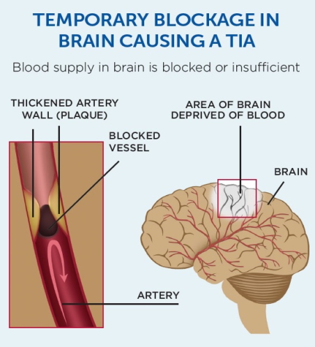 Shows an artery with a wall thickened by plaque causing the artery to narrow and block, depriving an area of the brain of blood.